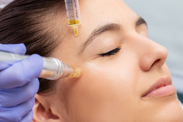 Collagen Induction Therapy