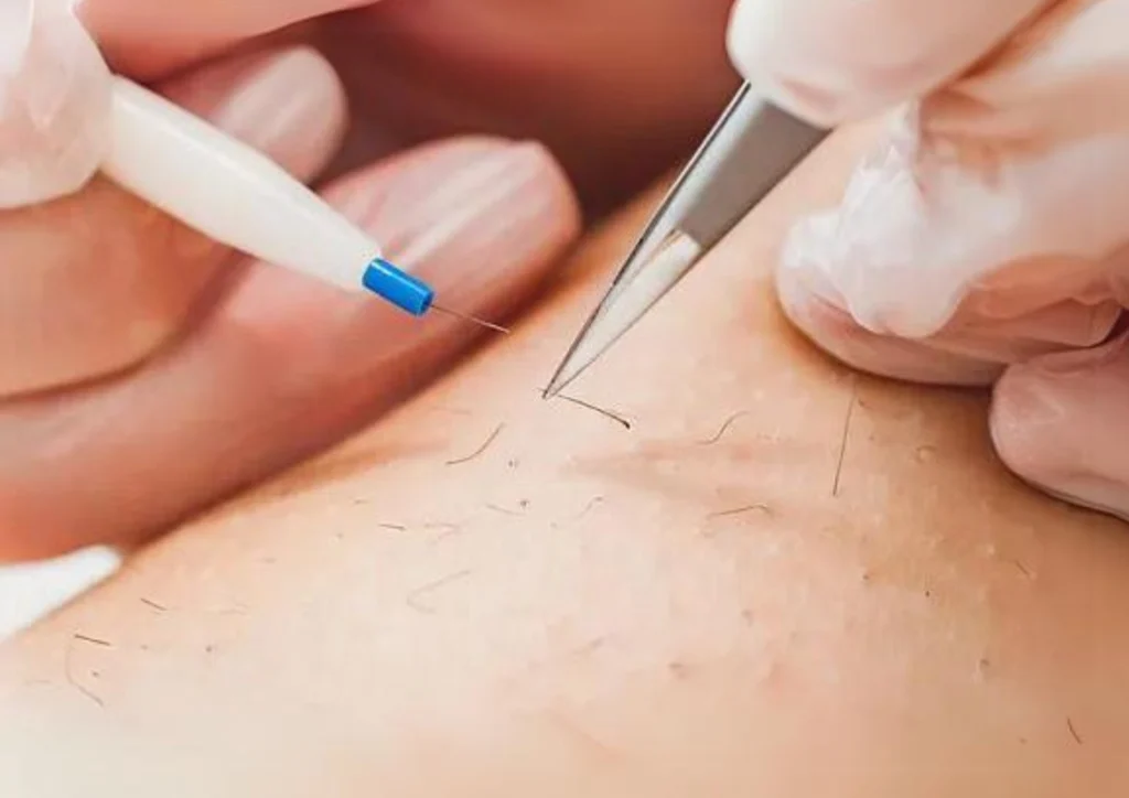 The Health Benefits of Permanent Hair Removal Through Electrolysis